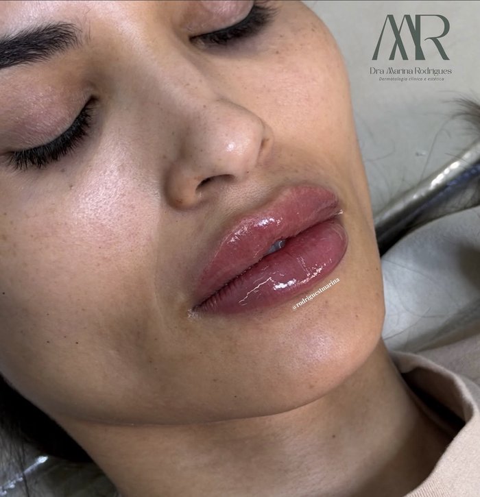 Preenchimento labial
